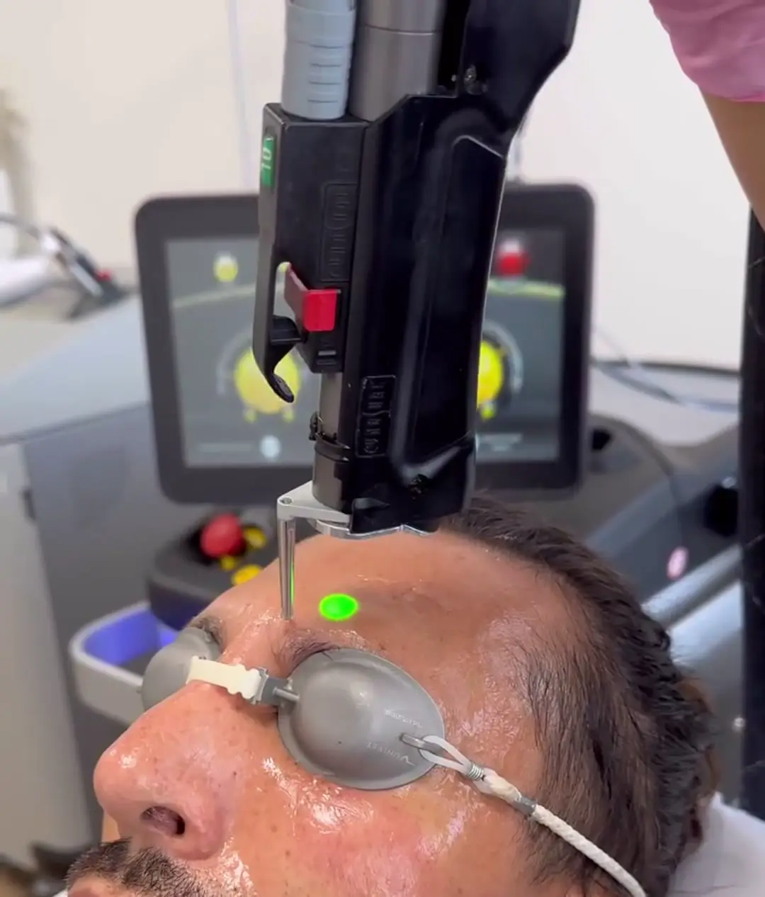 Photorajeunissement au laser Cynosure Elite iQ : la pièce à main et son spot vert de visée sur le front, coques de protection sur les yeux — SHAY Esthétique, Ahuntsic Montréal
